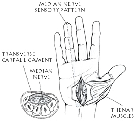 Carpal Tunnel Syndrome