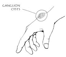 Ganglion Cysts